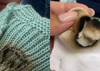 Polícia Civil conclui inquérito sobre queimadura em recém-nascido e indicia técnica de enfermagem